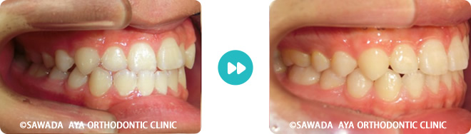 右側：反対咬合非抜歯治療術前術後