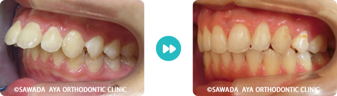 左側：出っ歯矯正治療の術前術後