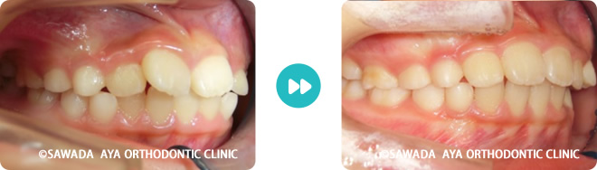 左側：中等度の凸凹歯並び術前術後