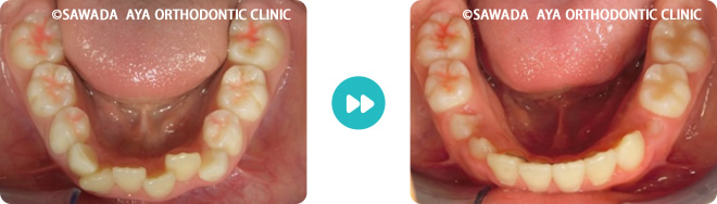 下顎：重度の凸凹歯並び術前術後