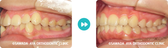 左側：凸凹の非抜歯治療術前術後