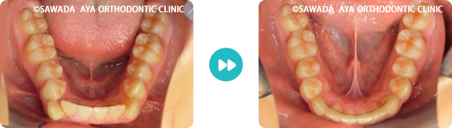 下顎：凸凹の非抜歯治療術前術後