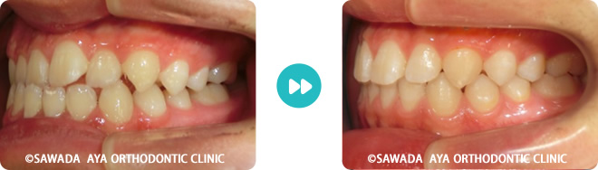 左側：反対咬合非抜歯治療術前術後