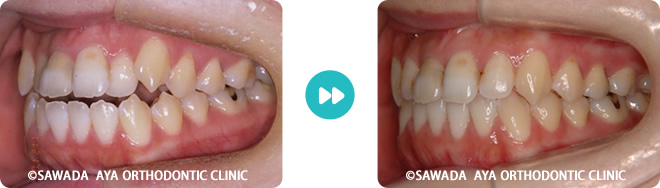 左側：開咬非抜歯治療術前術後