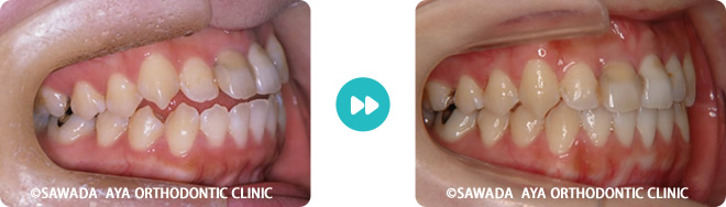 右側：開咬非抜歯治療術前術後