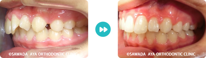 左側：凸凹歯非抜歯治療術前術後