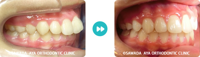 右側：凸凹歯非抜歯治療術前術後