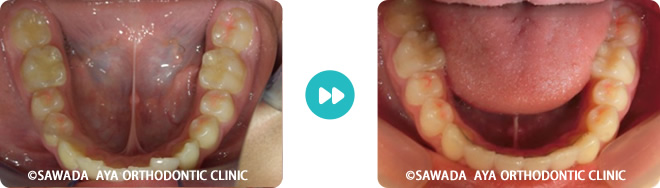下顎：凸凹歯非抜歯治療術前術後