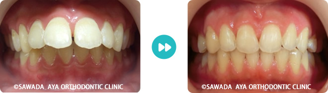 正面：出っ歯矯正治療の術前術後