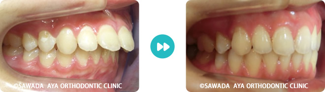 右側：出っ歯矯正治療の術前術後