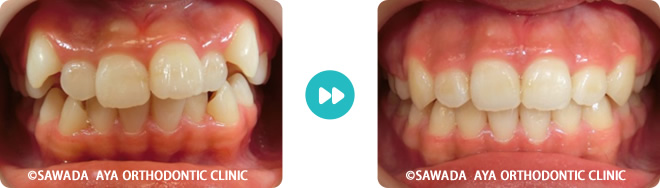 正面：凸凹歯矯正治療の術前術後