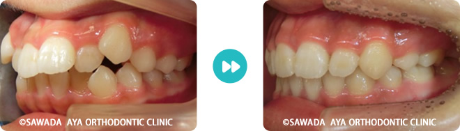 左側：凸凹歯矯正治療の術前術後