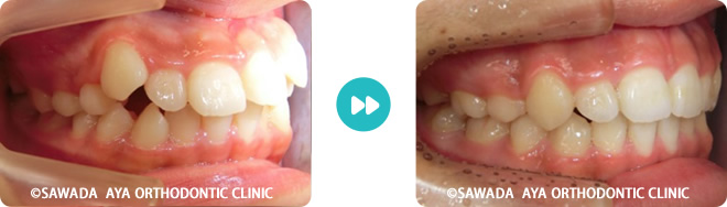 右側：凸凹歯矯正治療の術前術後
