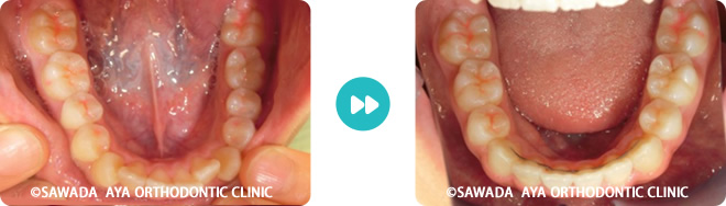 下顎：凸凹歯矯正治療の術前術後