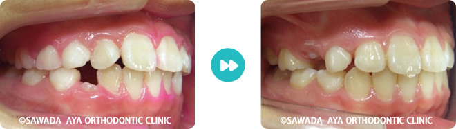 左側：凸凹の非抜歯治療術前術後