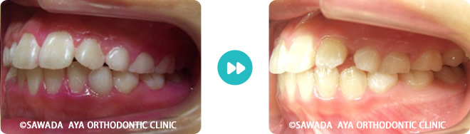右側：凸凹の非抜歯治療術前術後