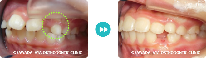 右側：中等度の凸凹歯並び術前術後