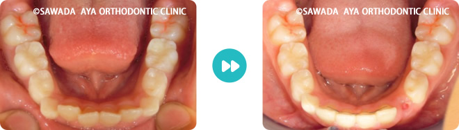 下顎：中等度の凸凹歯並び術前術後