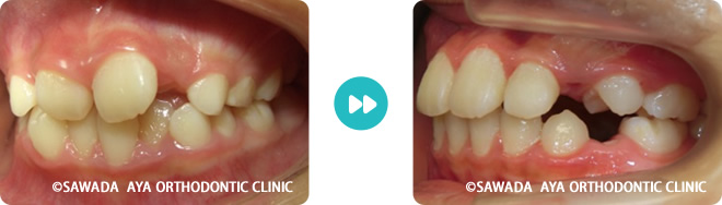右側：重度の凸凹歯並び術前術後
