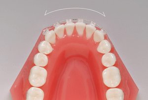前歯の部分矯正