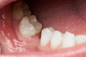 奥歯の部分矯正
